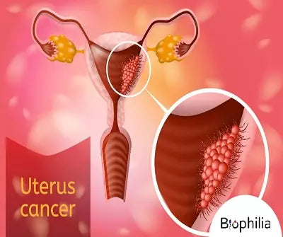 Can Endometriosis Trigger Cancer